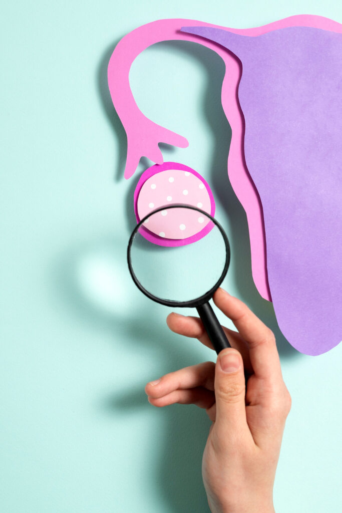 Polycystic ovaries image